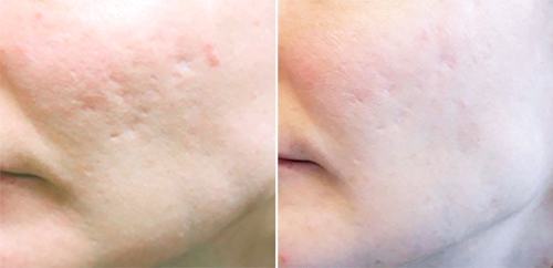 Akne ar på kind, før og efter behandling