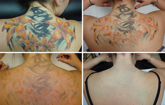 Fjernelse af mangefarvet tatovering på ryg, 4 trin
