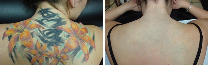 Fjernelse af mangefarvet tatovering på ryg, før/efter