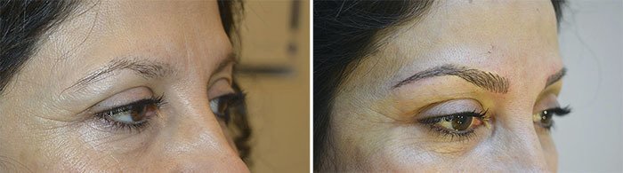 Før og efter mikropigmentering af øjenbryn