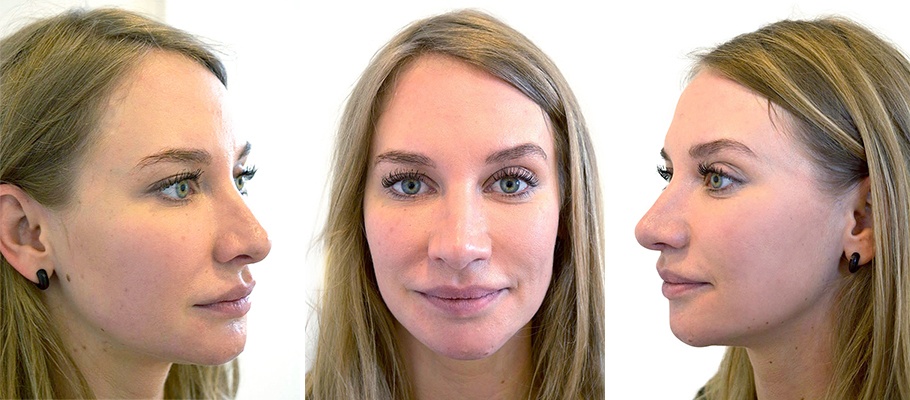 Kvinde 28 år, ansigt før behandling, 3 vinkler