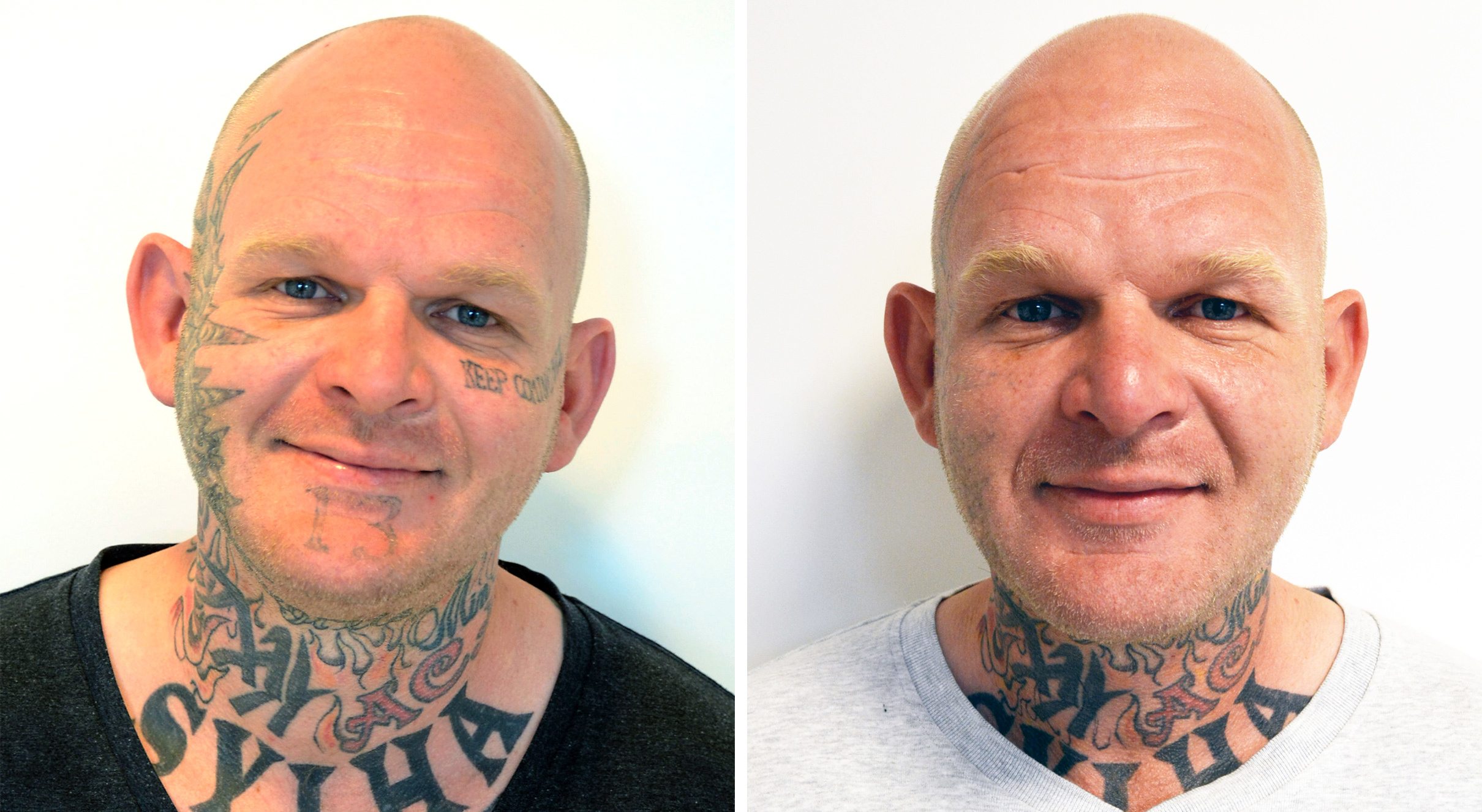 Ansigt forfra før og efter tatoveringsfjernelse