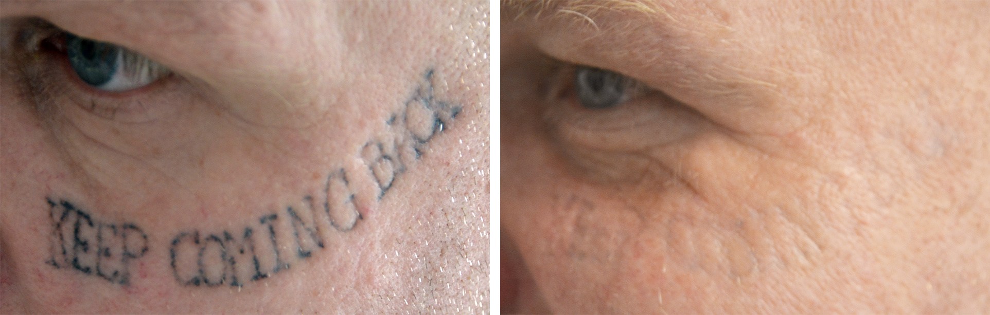 Ansigt skråt forfra før og efter tatoveringsfjernelse