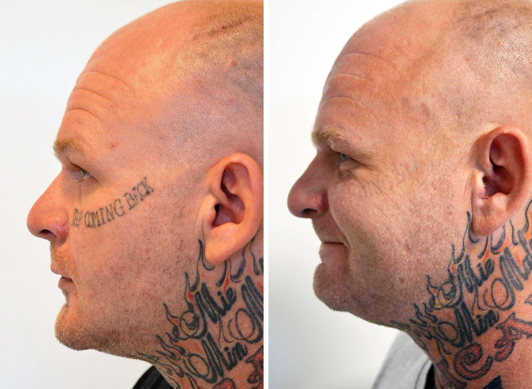 Ansigt fra siden før og efter tatoveringsfjernelse