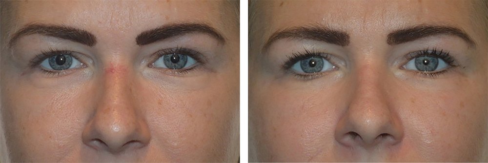 Karsprængninger på næsen - før og efter behandling