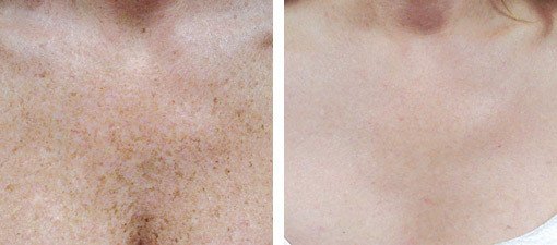 Behandling af pigmentpletter på øvre brystparti, før og efter