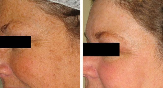 Behandling af pigment i ansigt med IPL, før og efter