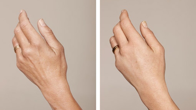 Før og efter hudforyngelse af hænder med Restylane Skinbooster
