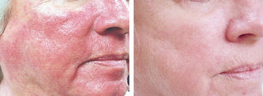 Rosacea behandling ansigt, før og efter