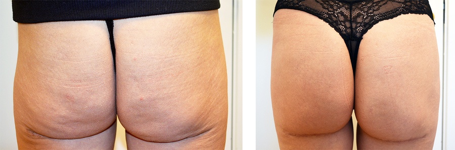 Butt-Lift før og efter 3. behandling