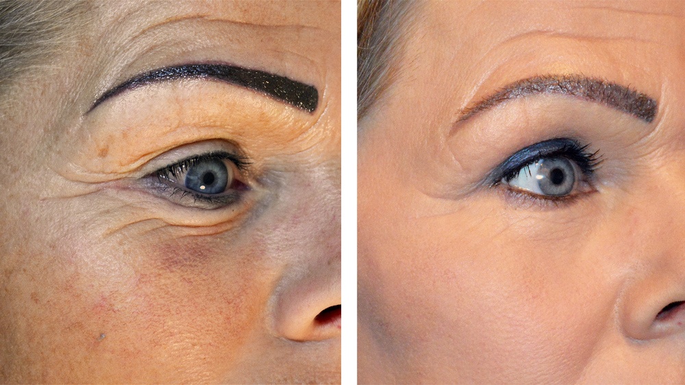 CO2 fractioneret laser under øjnene, før og efter 3. behandling