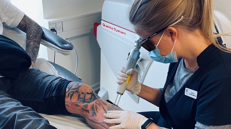Behandler fjerner tatovering på ben