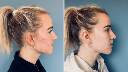 Akne ar før og efter behandling